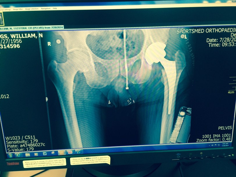 Hip new reality in place. Also x-rayed were my phone and zipper. Through.